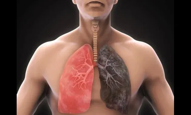 Quitting Smoking